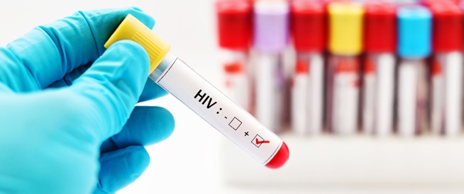 يحدث هذا المرض بسبب فيروس نقص المناعة البشرية (HIV)