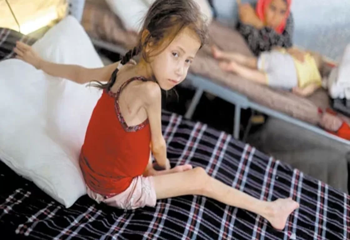 أطفال غزة... هياكل عظمية في مواجهة التجويع أطفال غزة... هياكل عظمية في مواجهة التجويع