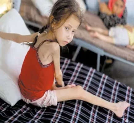 أطفال غزة... هياكل عظمية في مواجهة التجويع